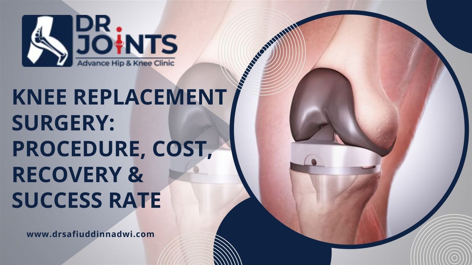 Knee Replacement Surgery: Procedure, Cost, Recovery & Success Rate
